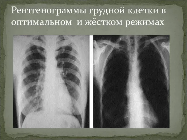 Рентгенограммы грудной клетки в оптимальном и жёстком режимах