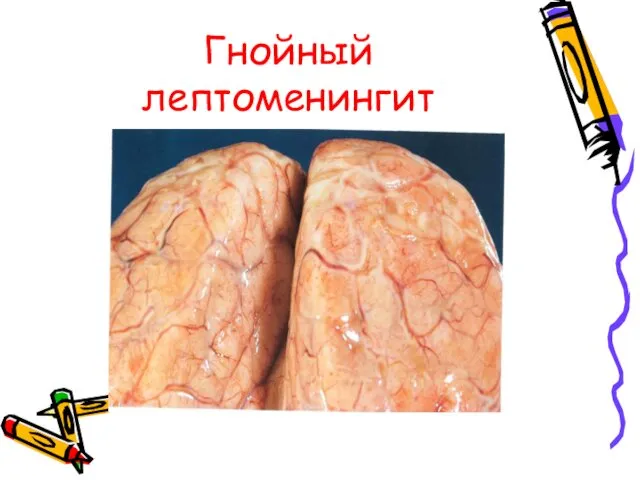 Гнойный лептоменингит