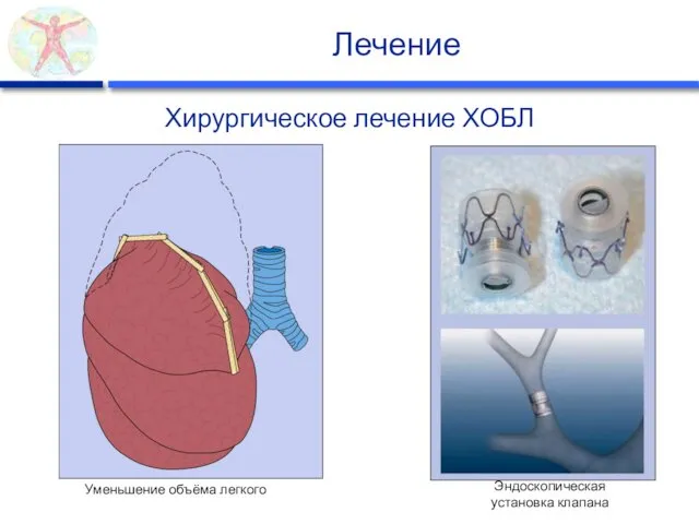 Лечение Хирургическое лечение ХОБЛ Уменьшение объёма легкого Эндоскопическая установка клапана
