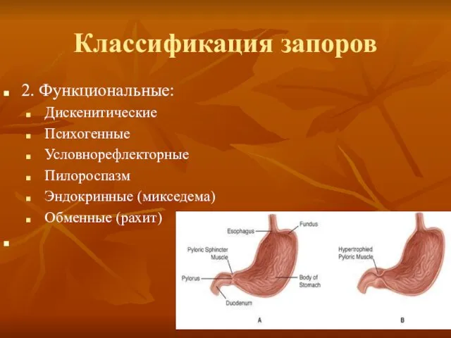 Классификация запоров 2. Функциональные: Дискенитические Психогенные Условнорефлекторные Пилороспазм Эндокринные (микседема) Обменные (рахит)