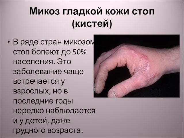 Микоз гладкой кожи стоп (кистей) В ряде стран микозом стоп болеют