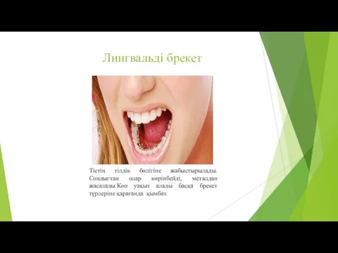 Лингвальді брекет Тістің тілдік бөлігіне жабыстырылады. Сондығтан олар көрінбейді, металдан жасалады.Көп