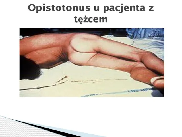 Opistotonus u pacjenta z tężcem