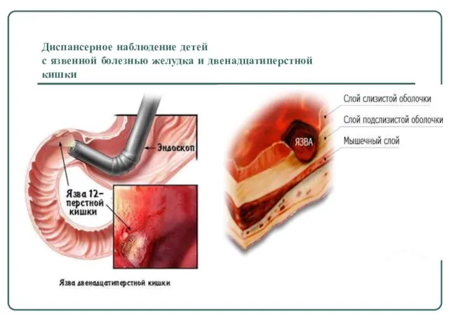 Диспансерное наблюдение детей с язвенной болезнью желудка и двенадцатиперстной кишки