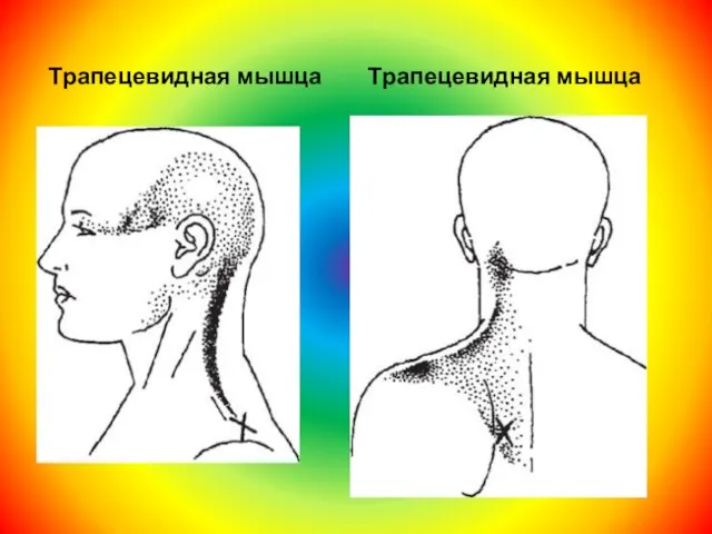 Трапецевидная мышца Трапецевидная мышца