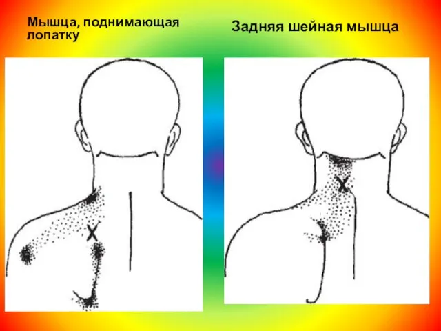 Мышца, поднимающая лопатку Задняя шейная мышца