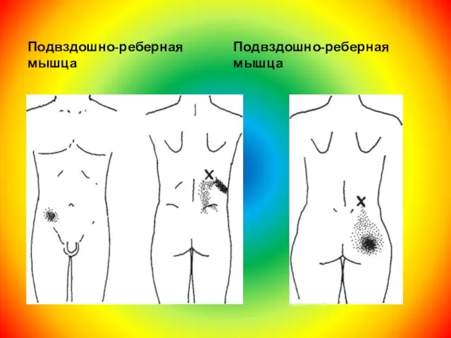 Подвздошно-реберная мышца Подвздошно-реберная мышца