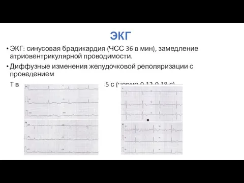 ЭКГ ЭКГ: синусовая брадикардия (ЧСС 36 в мин), замедление атриовентрикулярной проводимости.