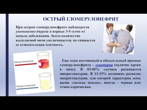 При остром гломерулонефрите наблюдается уменьшение диуреза в первые 3-5 суток от