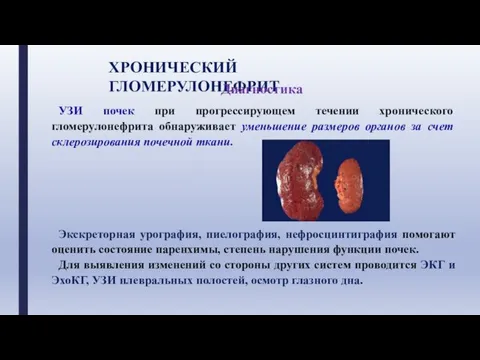 ХРОНИЧЕСКИЙ ГЛОМЕРУЛОНЕФРИТ Диагностика УЗИ почек при прогрессирующем течении хронического гломерулонефрита обнаруживает