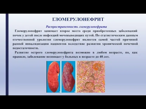 ГЛОМЕРУЛОНЕФРИТ Распространенность гломерулонефрита Гломерулонефрит занимает второе место среди приобретенных заболеваний почек