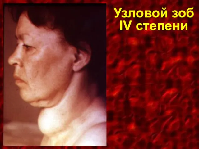 Узловой зоб IV степени