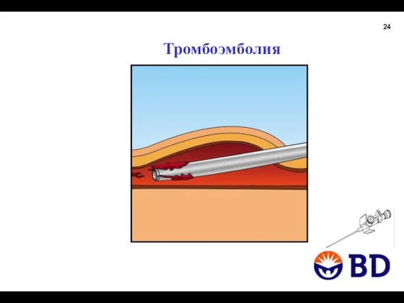 Тромбоэмболия 24