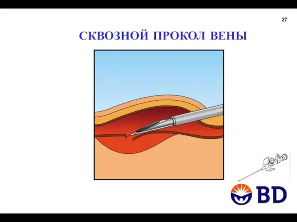 СКВОЗНОЙ ПРОКОЛ ВЕНЫ 27