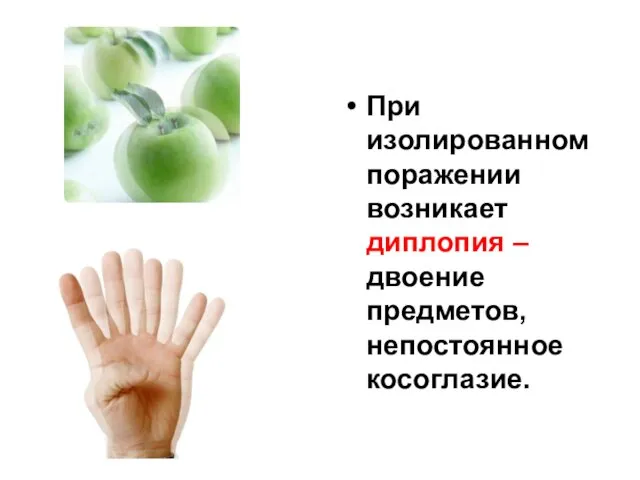 При изолированном поражении возникает диплопия – двоение предметов, непостоянное косоглазие.