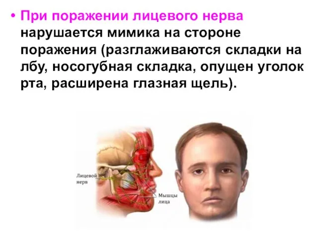 При поражении лицевого нерва нарушается мимика на стороне поражения (разглаживаются складки