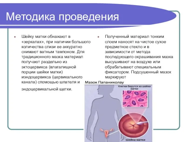 Методика проведения Шейку матки обнажают в «зеркалах», при наличии большого количества