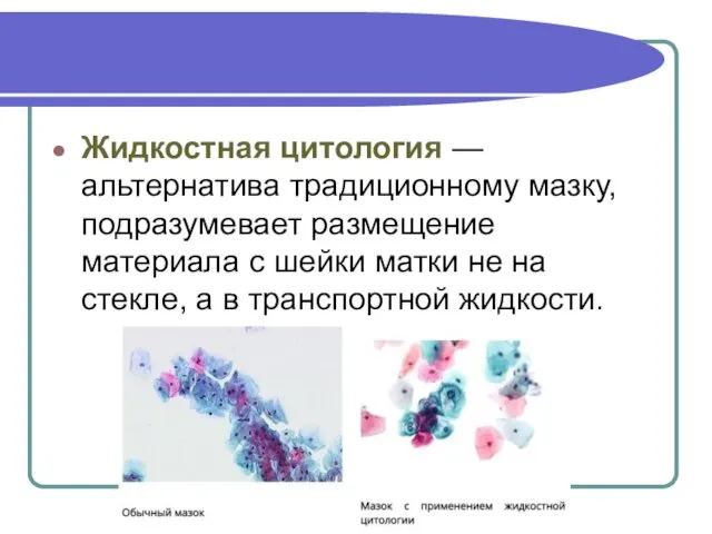 Жидкостная цитология — альтернатива традиционному мазку, подразумевает размещение материала с шейки