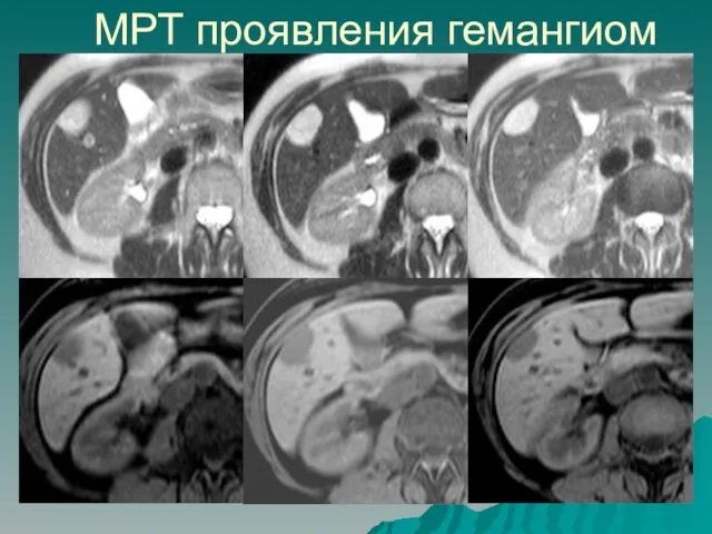 МРТ проявления гемангиом