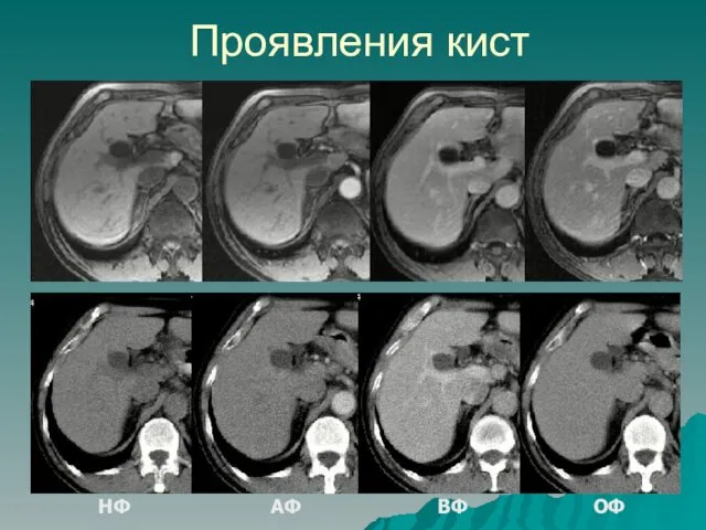 Проявления кист НФ АФ ВФ ОФ