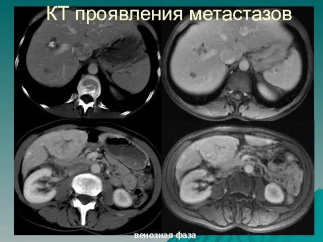 венозная фаза КТ проявления метастазов