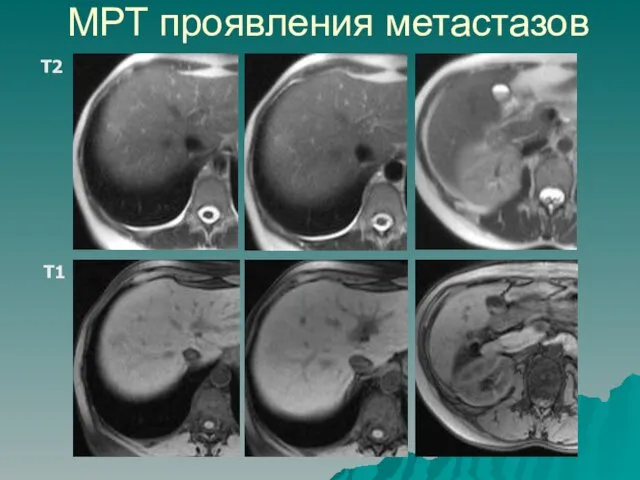 МРТ проявления метастазов Т2 Т1