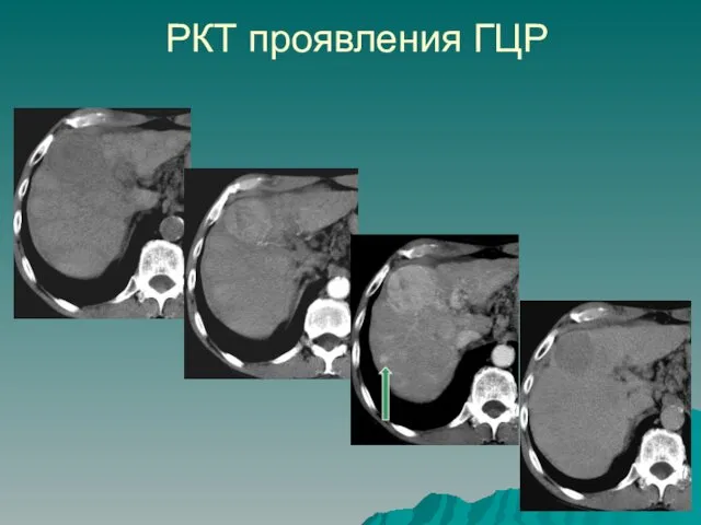 РКТ проявления ГЦР