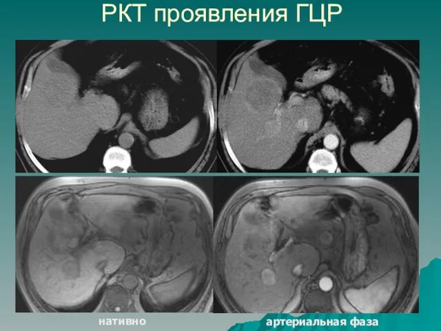 РКТ проявления ГЦР артериальная фаза нативно