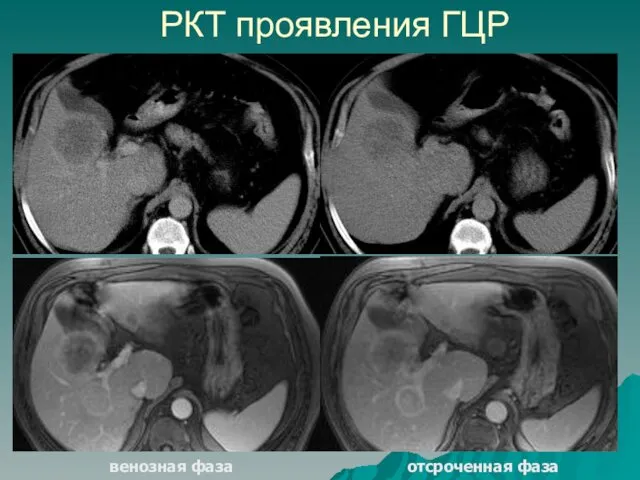 РКТ проявления ГЦР венозная фаза отсроченная фаза