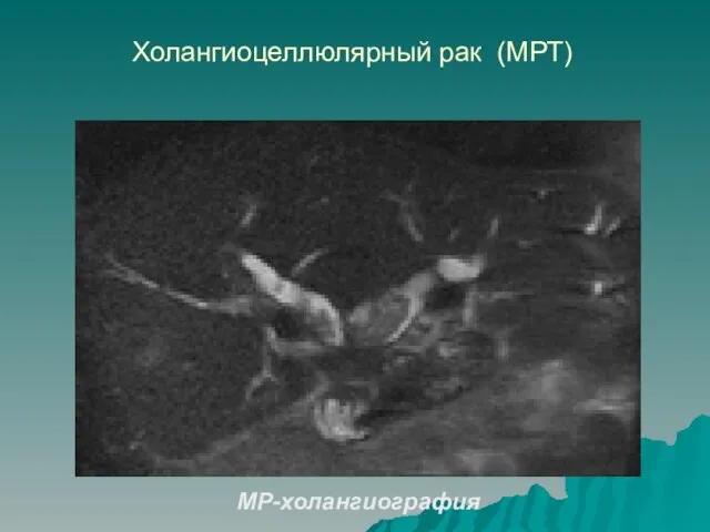 МР-холангиография Холангиоцеллюлярный рак (МРТ)