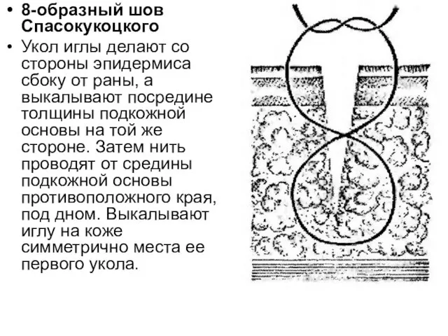 8-образный шов Спасокукоцкого Укол иглы делают со стороны эпидермиса сбоку от