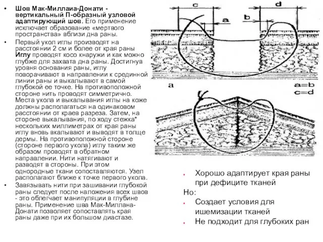 Шов Мак-Миллаиа-Донати - вертикальный П-образный узловой адаптирующий шов. Его применение исключает