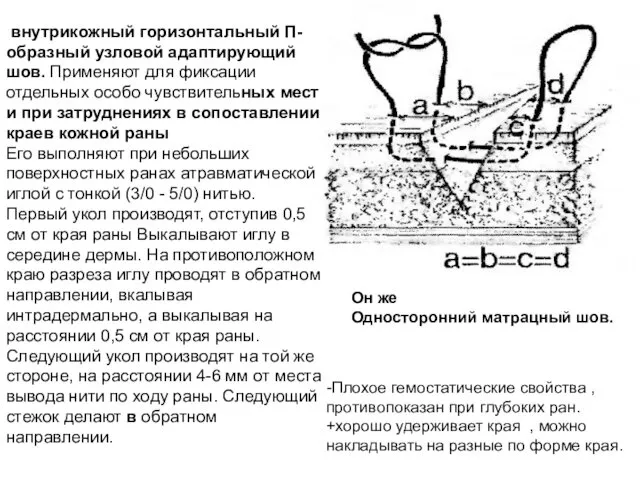 внутрикожный горизонтальный П-образный узловой адаптирующий шов. Применяют для фиксации отдельных особо