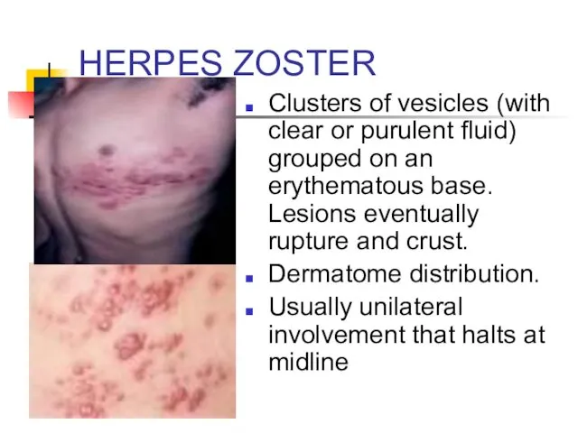 HERPES ZOSTER Clusters of vesicles (with clear or purulent fluid) grouped