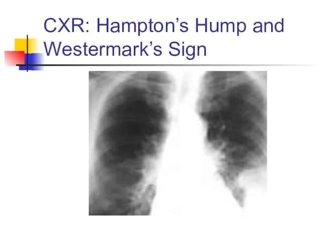 CXR: Hampton’s Hump and Westermark’s Sign