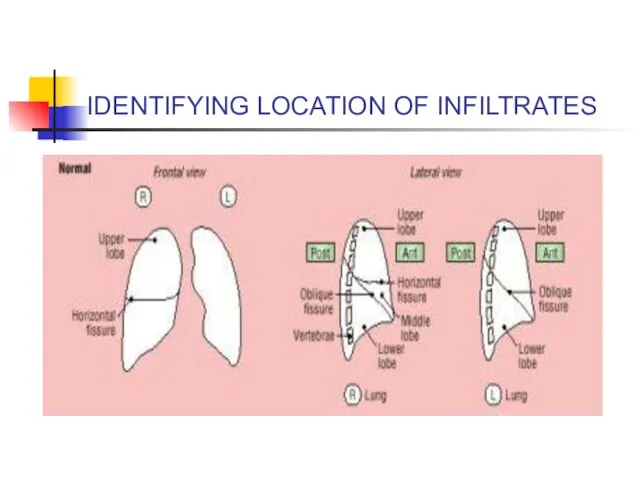 IDENTIFYING LOCATION OF INFILTRATES