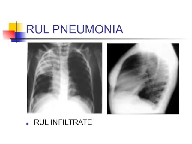 RUL PNEUMONIA RUL INFILTRATE