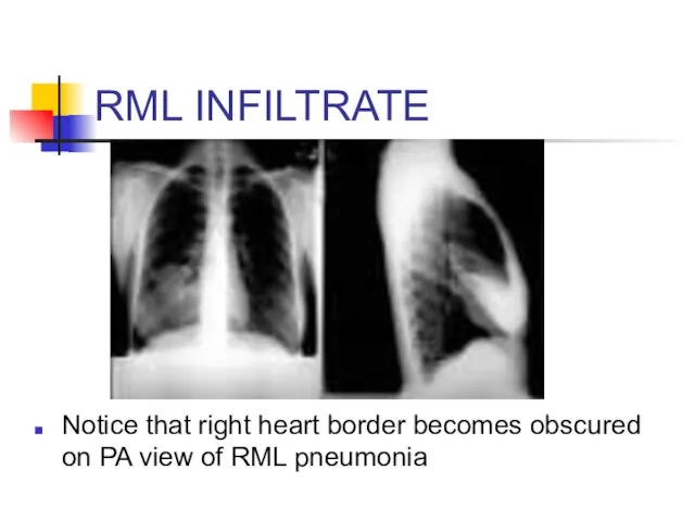 RML INFILTRATE Notice that right heart border becomes obscured on PA view of RML pneumonia