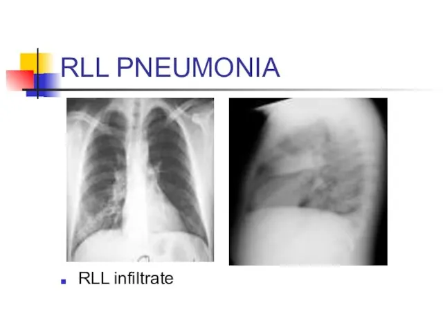 RLL PNEUMONIA RLL infiltrate