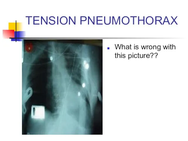 TENSION PNEUMOTHORAX What is wrong with this picture??