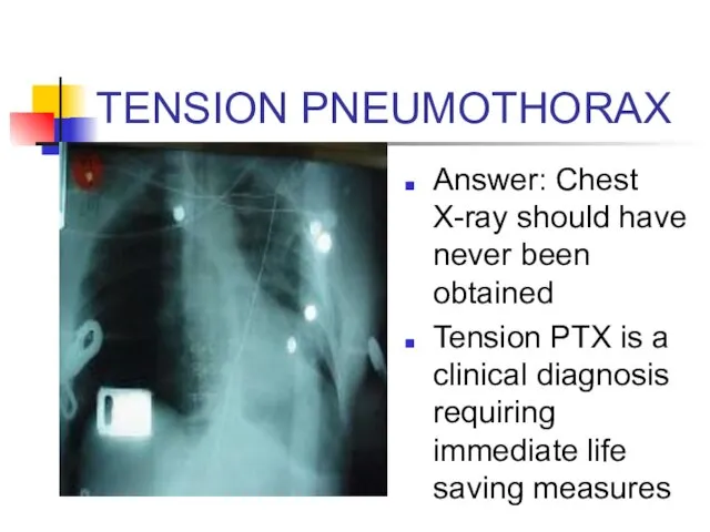 TENSION PNEUMOTHORAX Answer: Chest X-ray should have never been obtained Tension