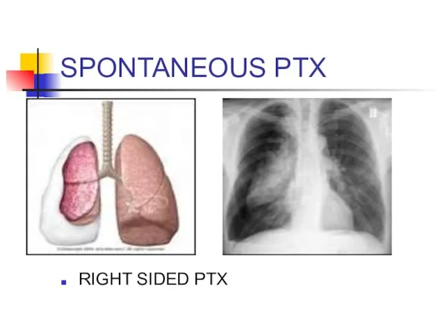 SPONTANEOUS PTX RIGHT SIDED PTX