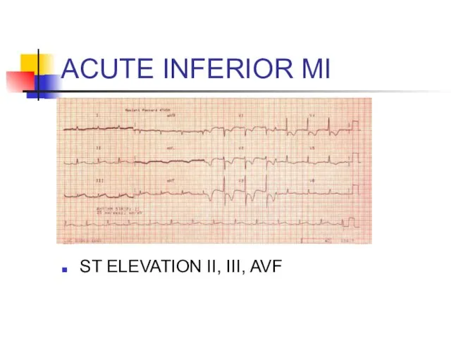 ACUTE INFERIOR MI ST ELEVATION II, III, AVF