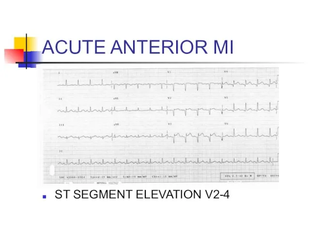 ACUTE ANTERIOR MI ST SEGMENT ELEVATION V2-4