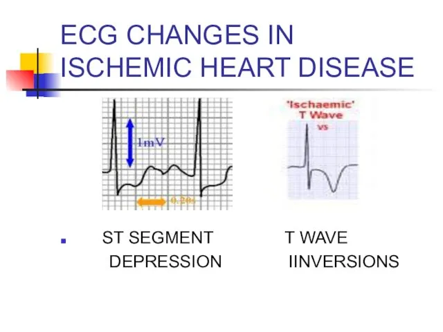 EСG CHANGES IN ISCHEMIC HEART DISEASE ST SEGMENT T WAVE DEPRESSION IINVERSIONS