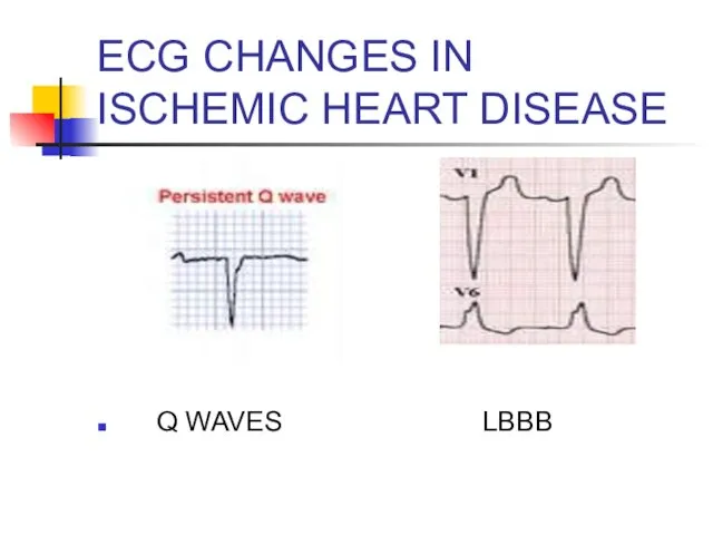 EСG CHANGES IN ISCHEMIC HEART DISEASE Q WAVES LBBB