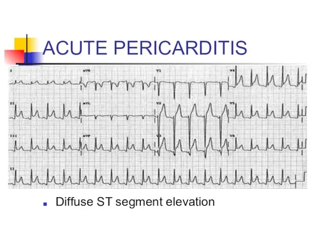 ACUTE PERICARDITIS Diffuse ST segment elevation