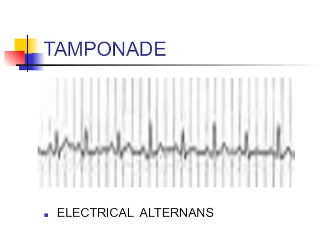 TAMPONADE ELECTRICAL ALTERNANS