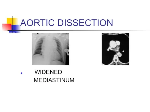 AORTIC DISSECTION WIDENED MEDIASTINUM