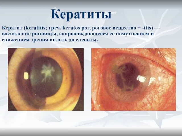 Кератиты Кератит (keratitis; греч. keratos рог, роговое вещество + -itis) —